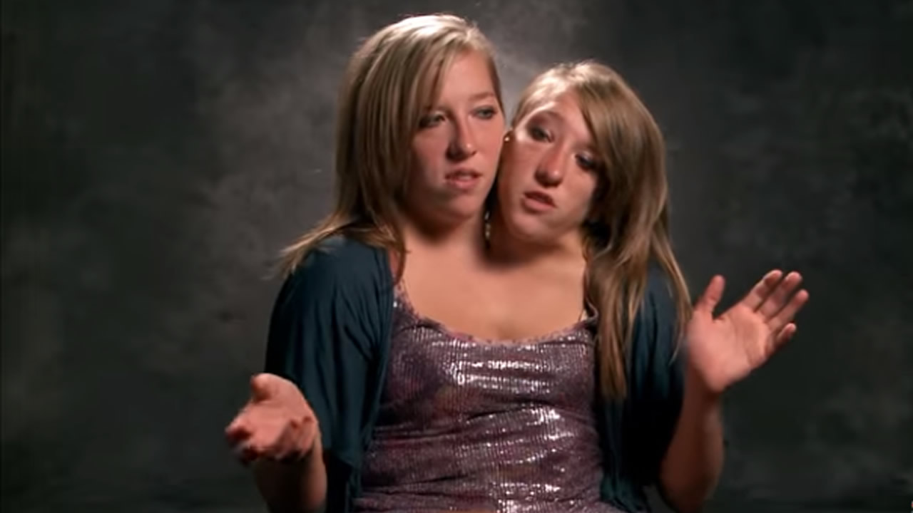 El ejemplo de superación de estas siamesas que sorprende al mundo